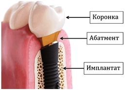 Строение зубного импланта
